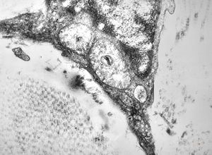 M, 10y. | Coffin-Lowry syndrome - skin